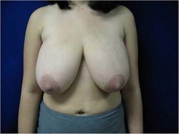 Breast Reduction Before & After Image