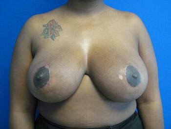 Breast Reduction Before & After Image