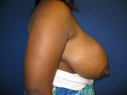 Breast Reduction Before & After Image