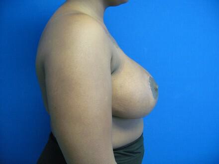Breast Reduction Before & After Image