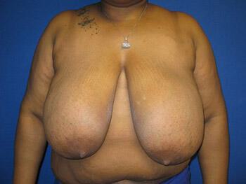 Breast Reduction Before & After Image