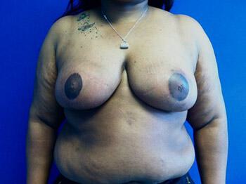 Breast Reduction Before & After Image