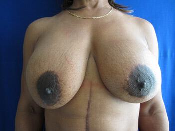 Revision Breast Surgery Before & After Image
