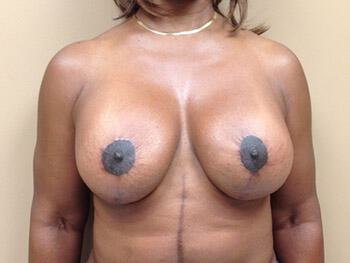 Revision Breast Surgery Before & After Image