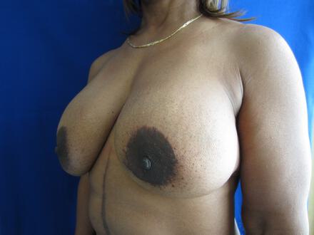 Revision Breast Surgery Before & After Image