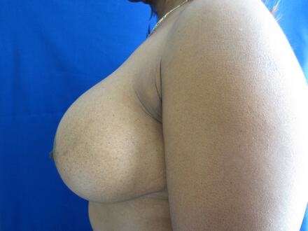 Revision Breast Surgery Before & After Image