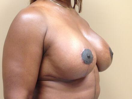 Revision Breast Surgery Before & After Image