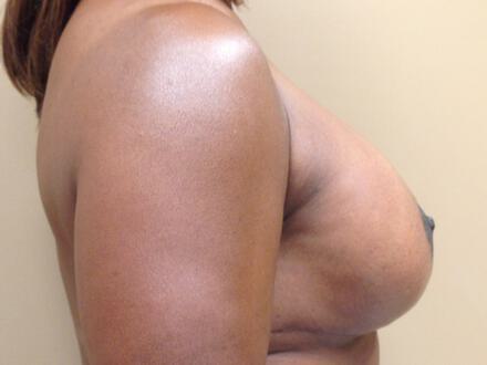 Revision Breast Surgery Before & After Image