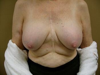 Revision Breast Surgery Before & After Image