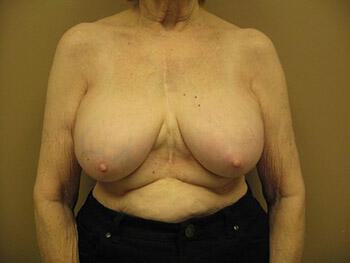 Revision Breast Surgery Before & After Image