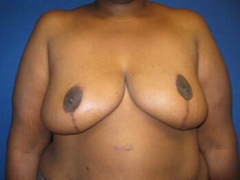 Revision Breast Surgery Before & After Image
