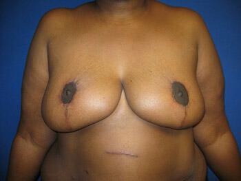 Revision Breast Surgery Before & After Image