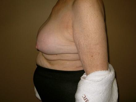 Revision breast surgery Before & After Image