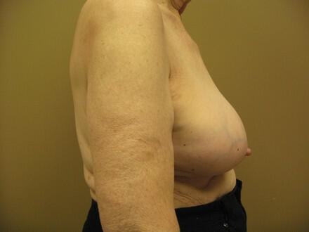 Revision breast surgery Before & After Image