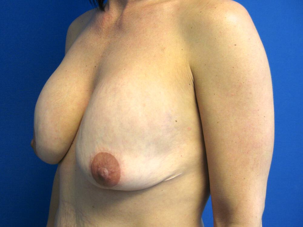Revision Breast Surgery Before & After Image