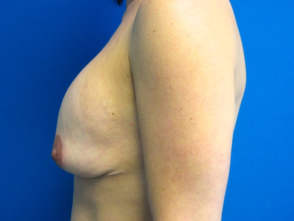Revision Breast Surgery Before & After Image