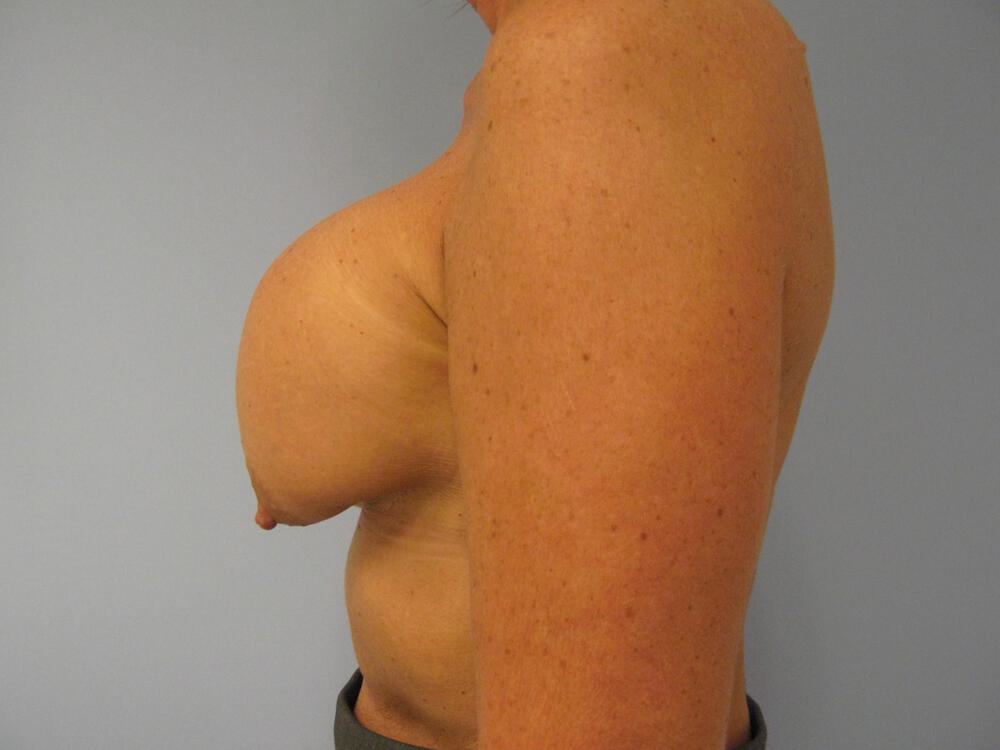 Revision breast surgery Before & After Image