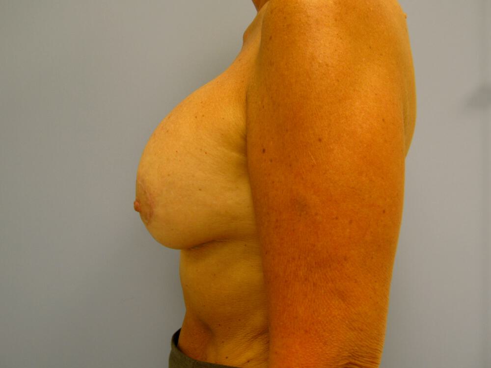 Revision breast surgery Before & After Image