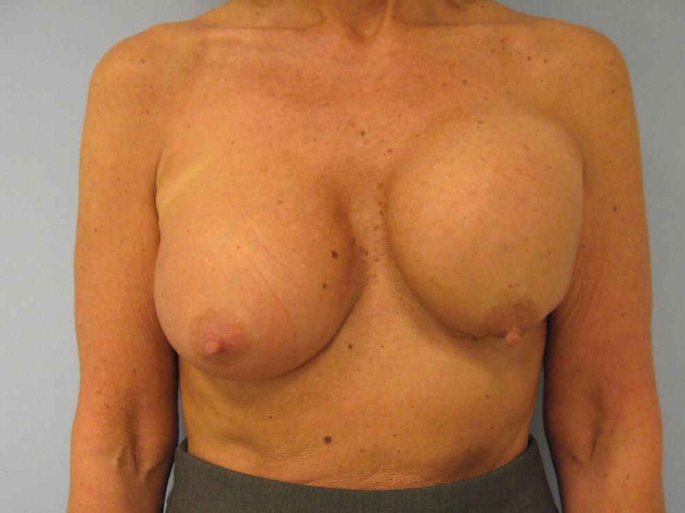 Revision breast surgery Before & After Image