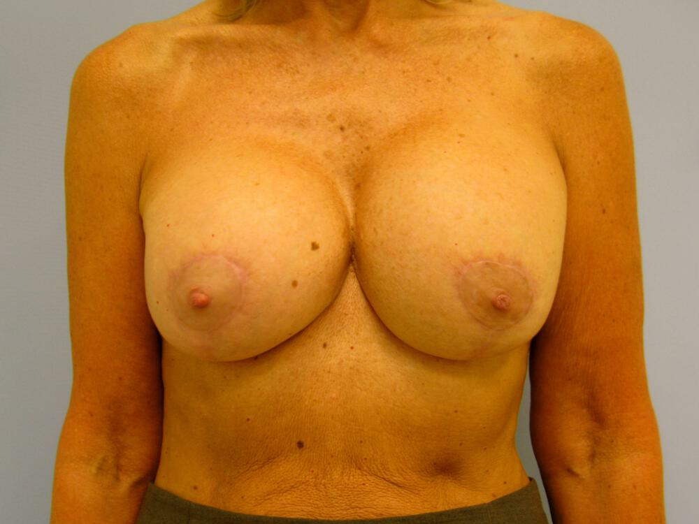 Revision breast surgery Before & After Image