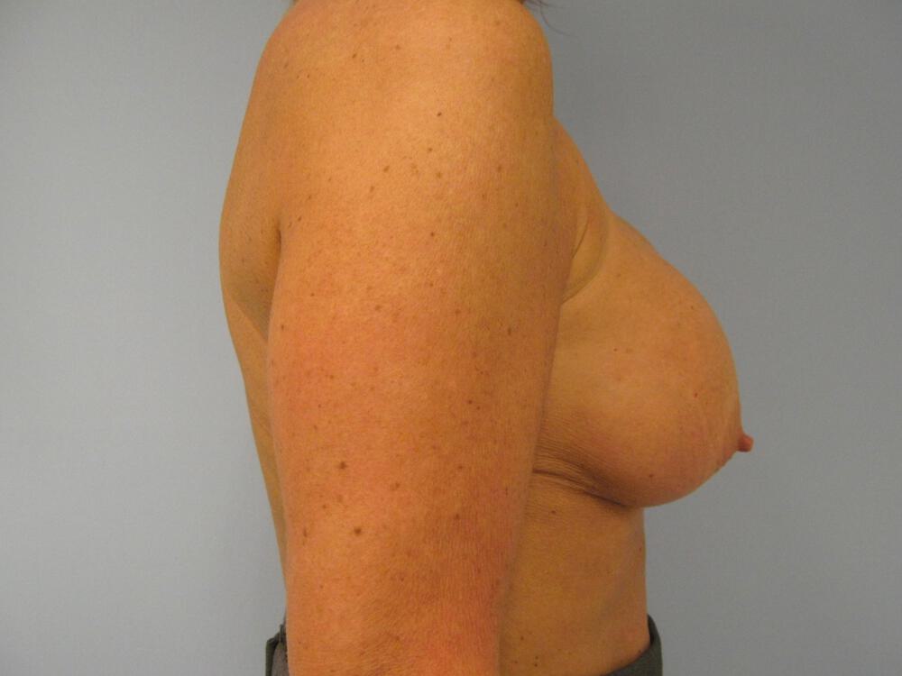 Revision Breast Surgery Before & After Image