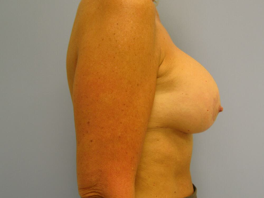 Revision Breast Surgery Before & After Image