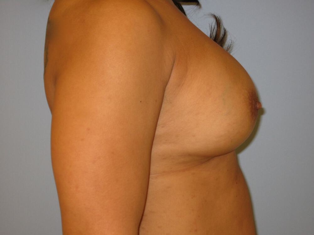 Revision Breast Surgery Before & After Image