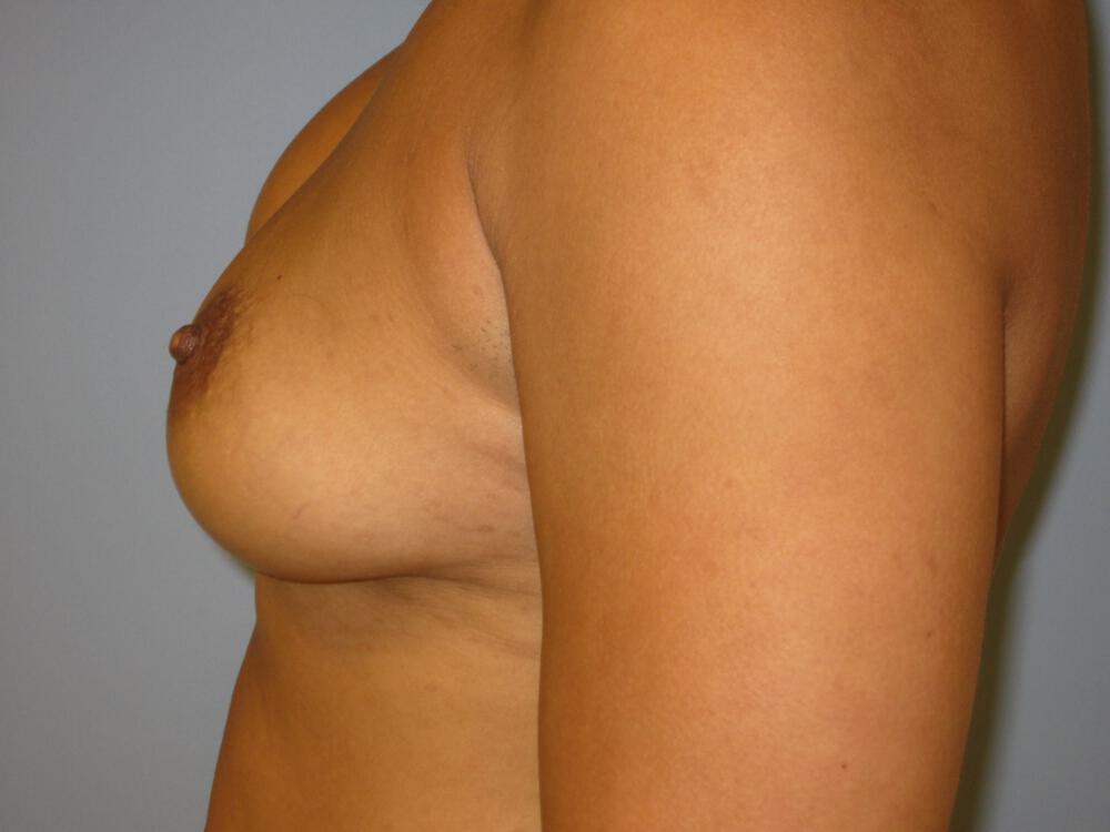Revision Breast Surgery Before & After Image