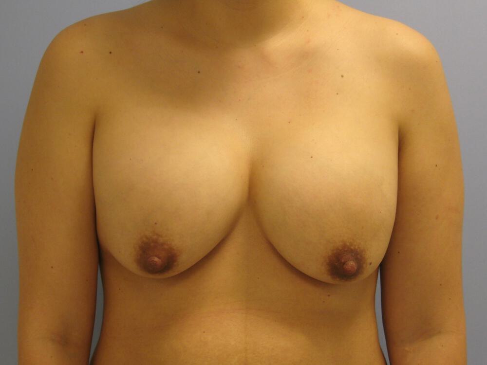 Revision breast surgery Before & After Image