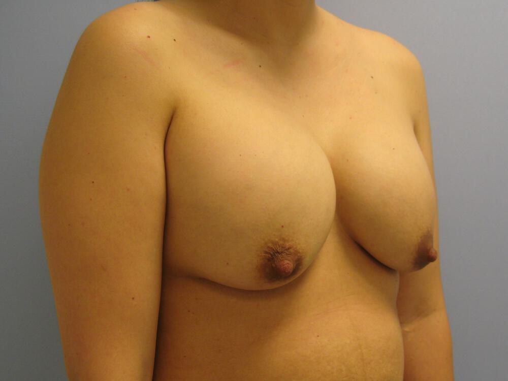 Revision breast surgery Before & After Image