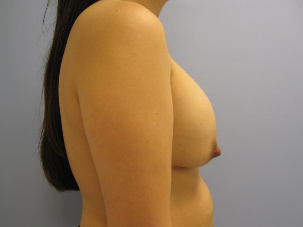 Revision Breast Surgery Before & After Image