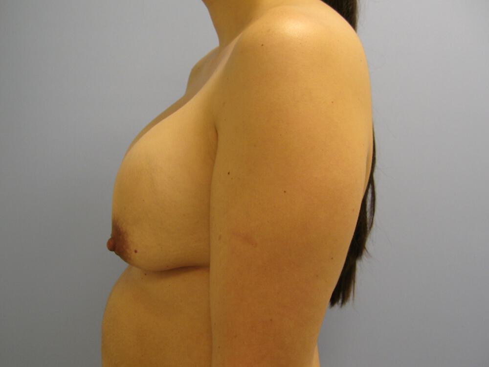 Revision Breast Surgery Before & After Image