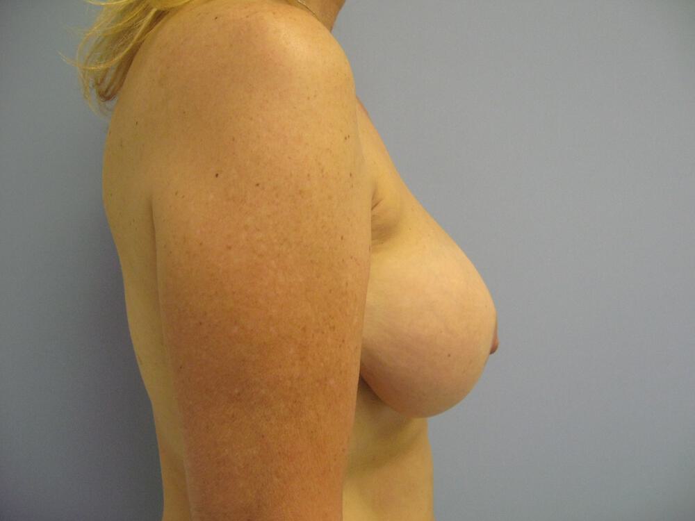 Revision breast surgery Before & After Image
