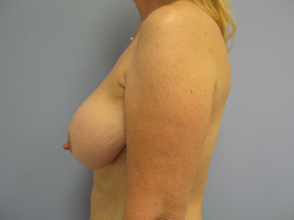 Revision Breast Surgery Before & After Image