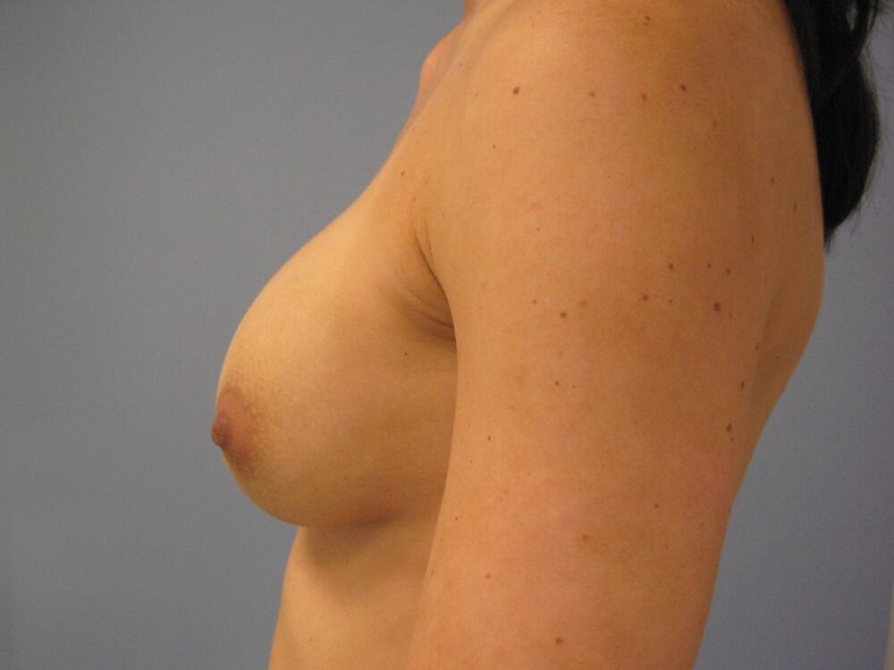 Revision Breast Surgery Before & After Image