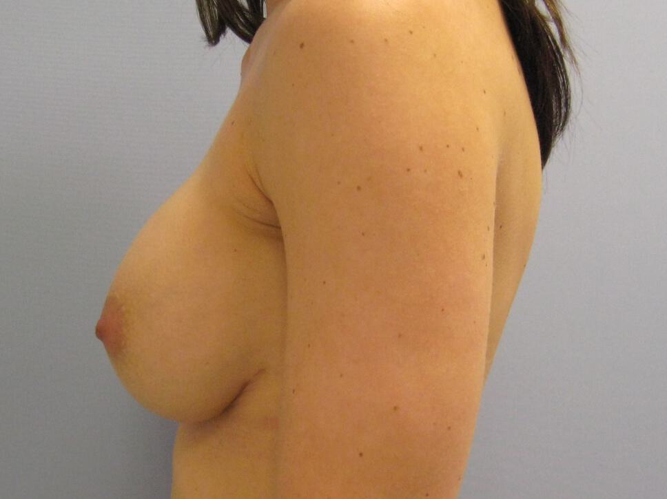 Revision Breast Surgery Before & After Image