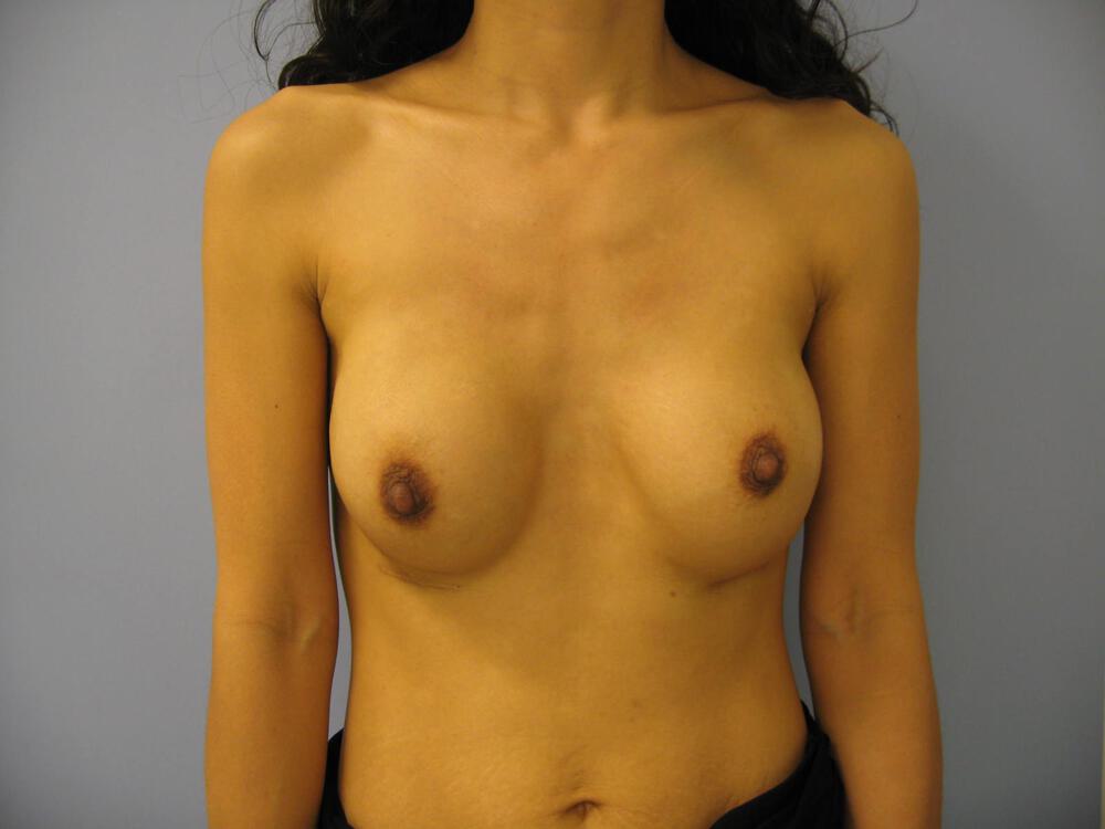 Revision breast surgery Before & After Image