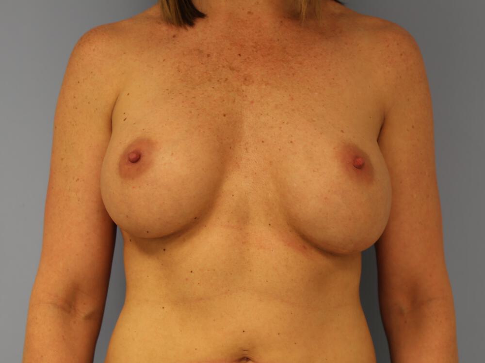 Revision breast surgery Before & After Image
