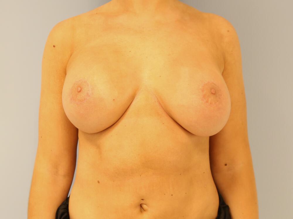 Revision breast surgery Before & After Image
