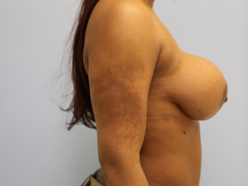 Revision Breast Surgery Before & After Image