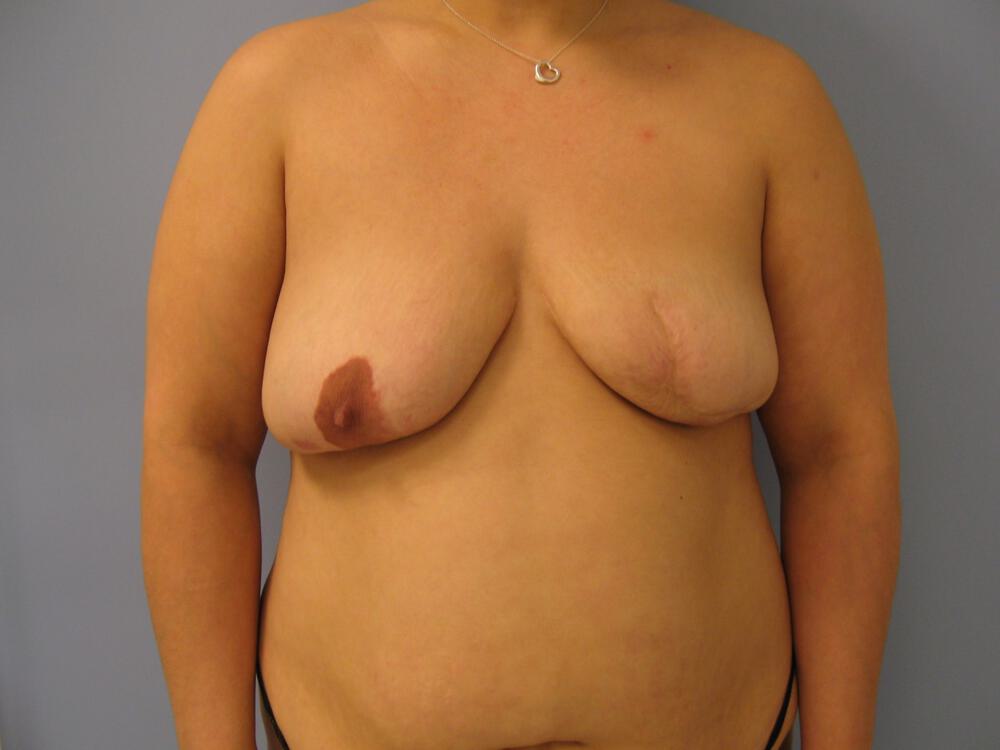 Revision breast surgery Before & After Image