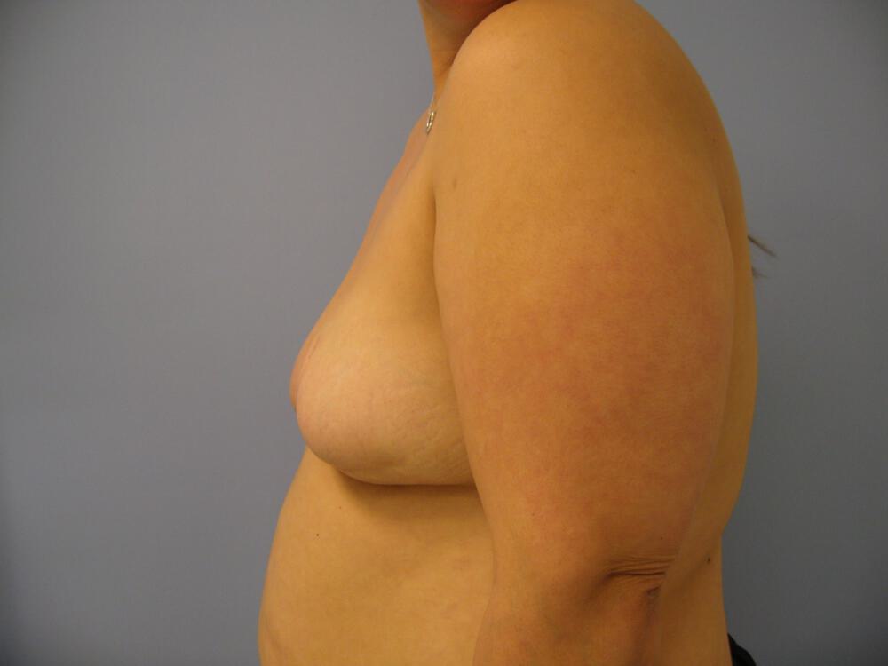 Revision breast surgery Before & After Image
