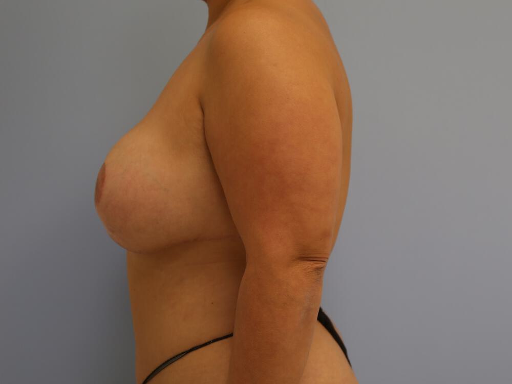 Revision breast surgery Before & After Image