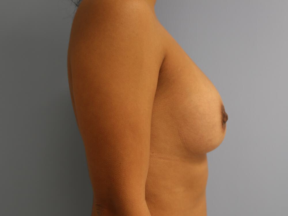 Revision breast surgery Before & After Image