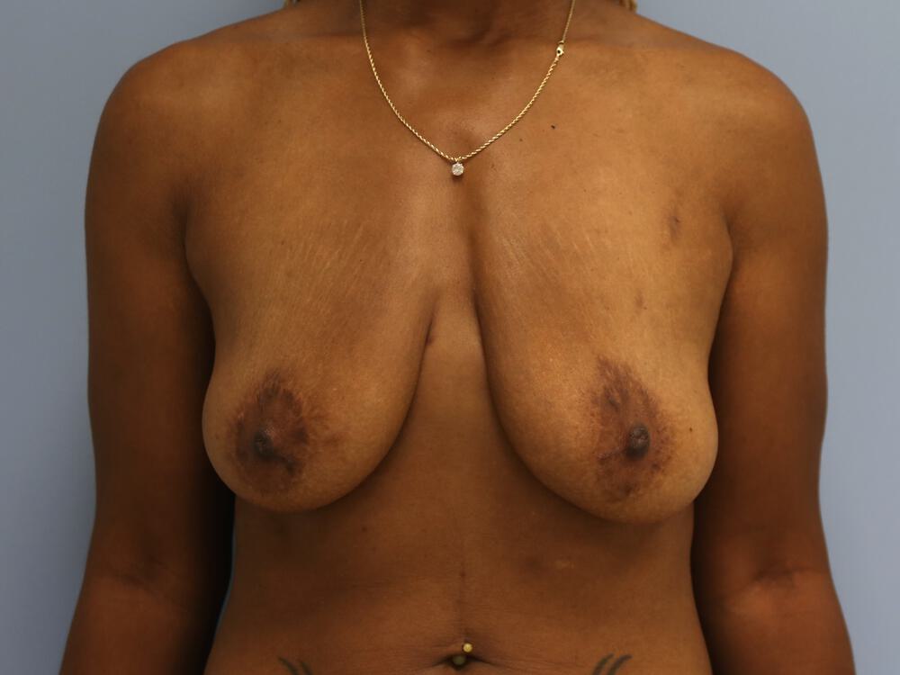 Revision breast surgery Before & After Image