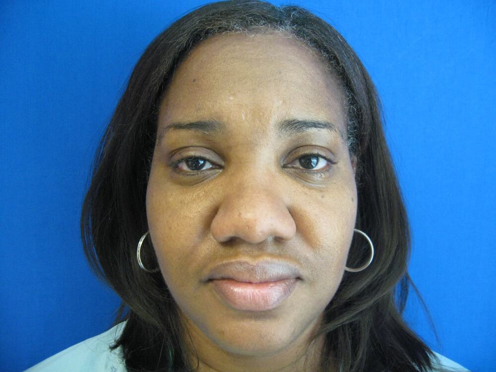 African American Rhinoplasty Before & After Image