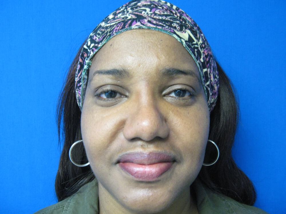 African American Rhinoplasty Before & After Image