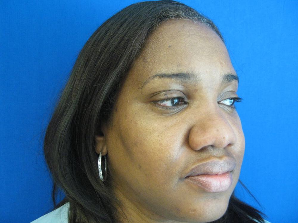 African American Rhinoplasty Before & After Image