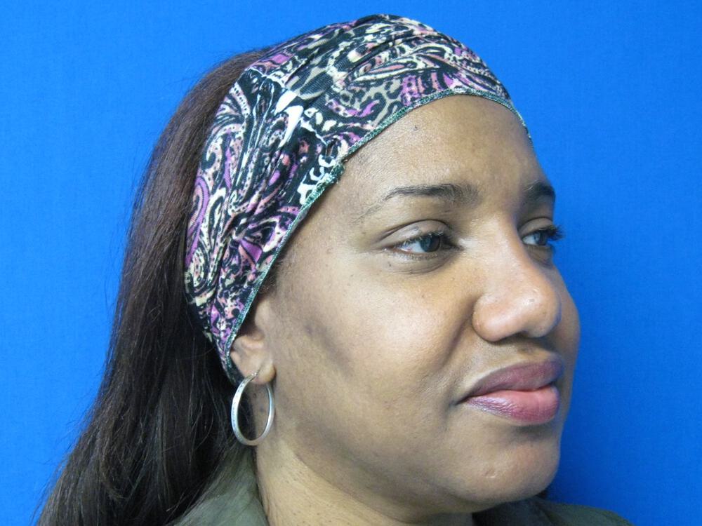 African American Rhinoplasty Before & After Image