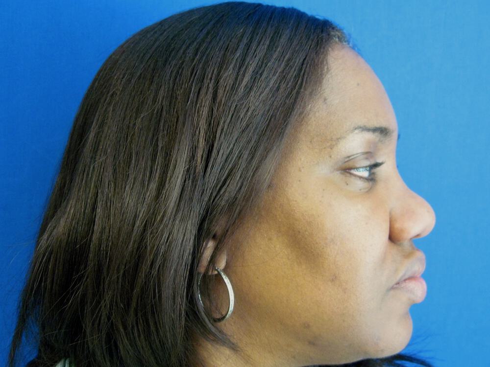 African American Rhinoplasty Before & After Image